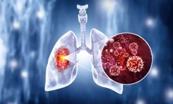 Geçmeyen Öksürük ve Nefes Darlığı Varsa Akciğer Kanserinden Şüphe Edilmeli